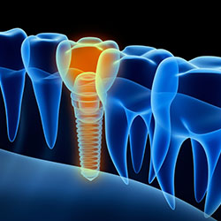Välitön implantti: tosiasiat ja edut yhdellä silmäyksellä, Dentolo