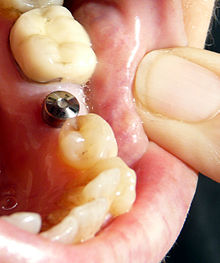 Implanttimuodot - implanttijärjestelmät - implanttityypit hammasimplantit