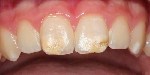 Liituhampaiden hampaat - yleinen pehmittimien aiheuttama sairaus, dr