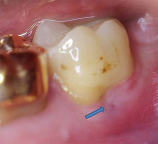 Kirurginen mikroskooppi: endodontia dr