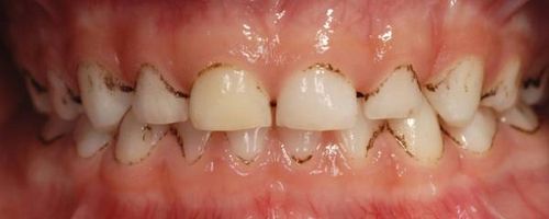 Mustat hampaat (musta tahra