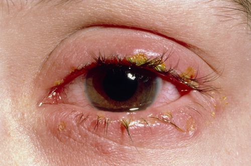 Liimatut silmät - krooninen sairaus? • yleislääkäri verkossa